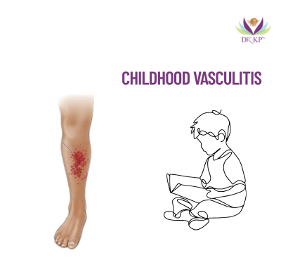 Childhood Vasculitis: Recognizing This Rare Condition